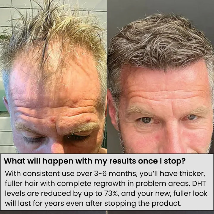 Regain Now™ Hair Regrowth System