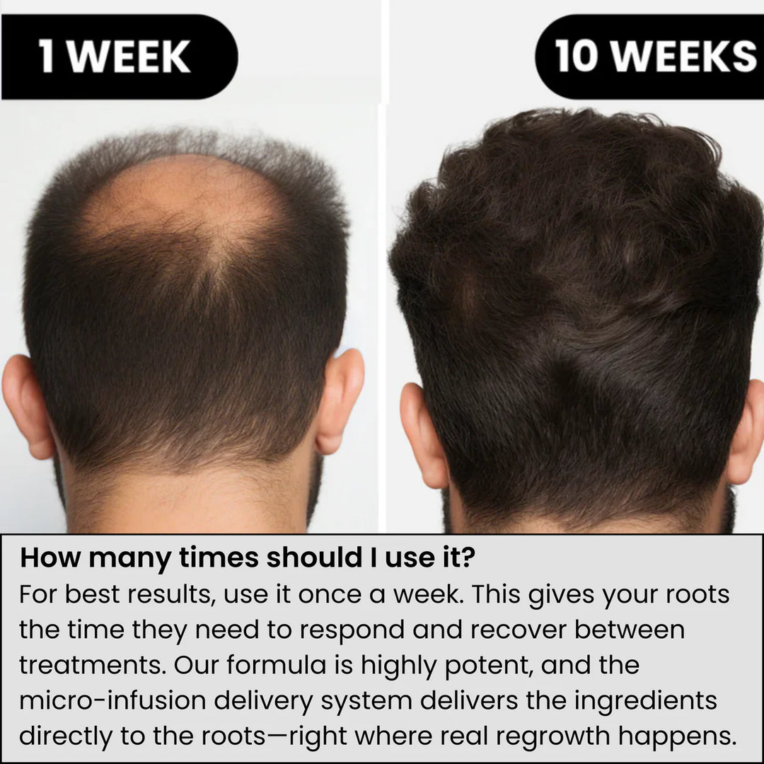 Regain Now™ Hair Regrowth System