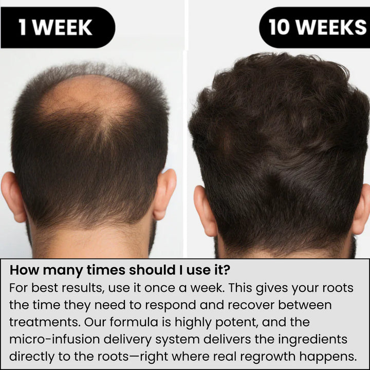 Regain Now™ Hair Regrowth System